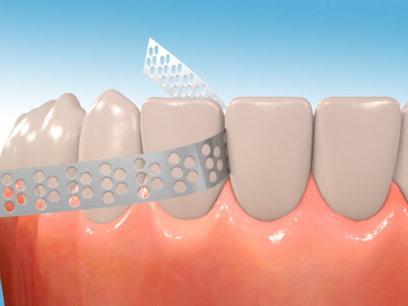 Tarpdančių “prišlifavimas” ortodontinio gydymo metu