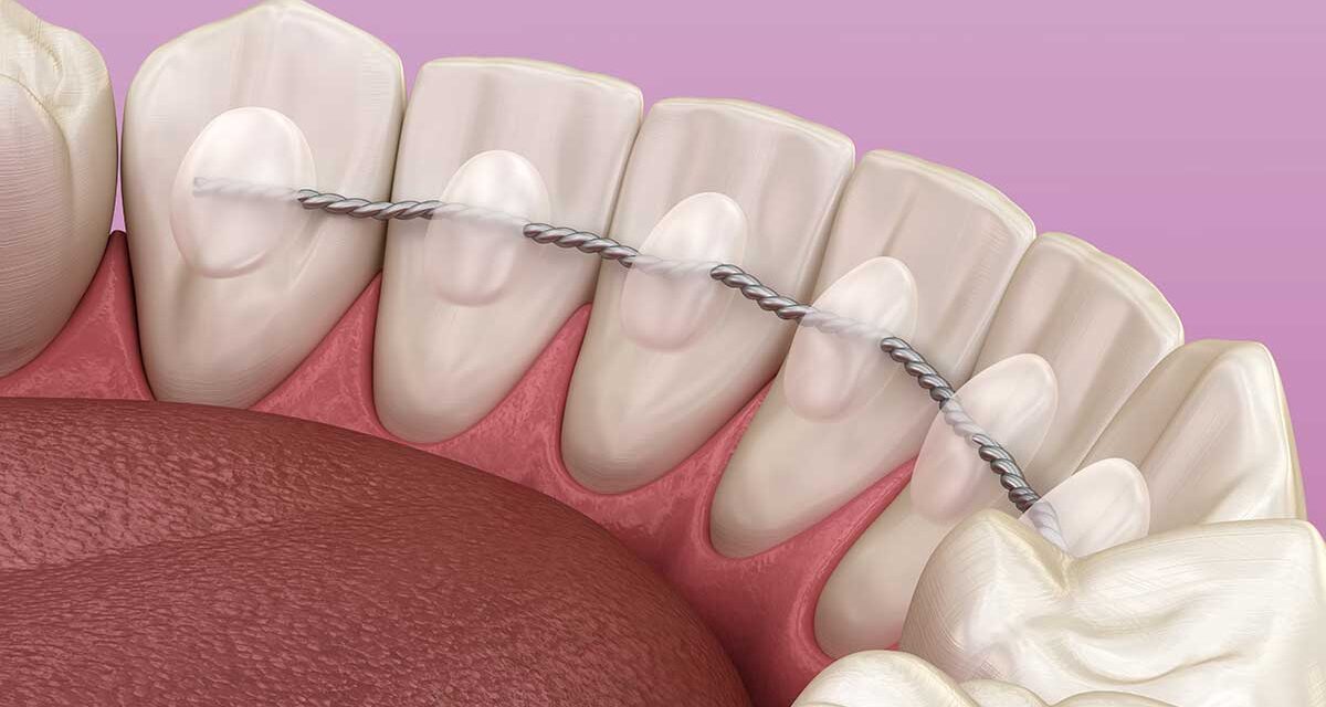 Ortodontinė retencinė vielutė – ką reikia žinoti?