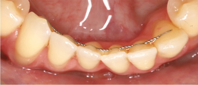 Pakartotinis dantų susigrūdimas (po ortodontinio gydymo). Ką daryti?