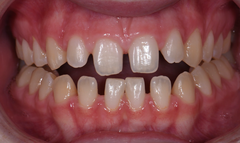 Tarpai tarp dantų: kokie galimi “uždarymo” būdai?