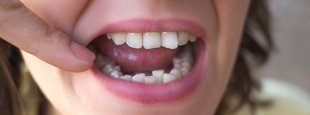 Kaip koreguojamas dantų susigrūdimas?