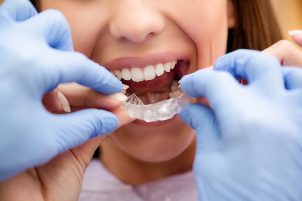 Kas atlieka dantų tiesinimą kapomis?