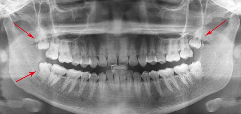 Ar būtina pašalinti protinius dantis prieš dantų tiesinimą kapomis?