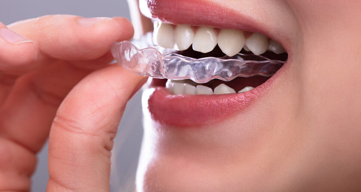 Susigrūdę dantys: ar galimas dantų tiesinimas kapomis?